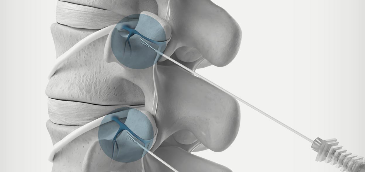 Facettendenervierung